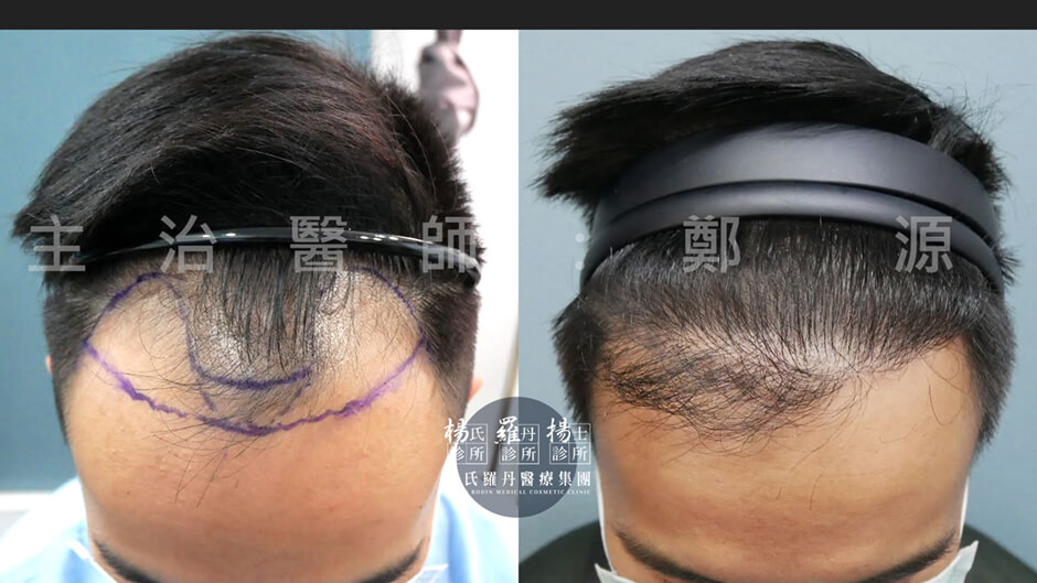 植髮 髮際線植髮 植髮成果