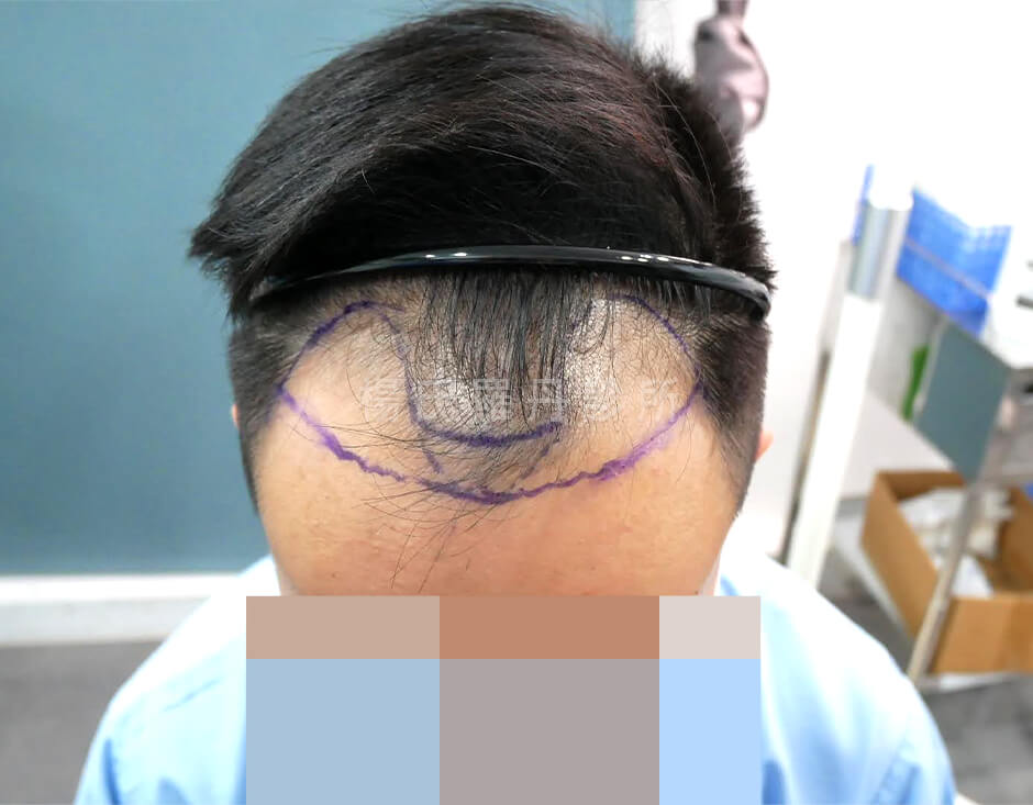 植髮 禿頭