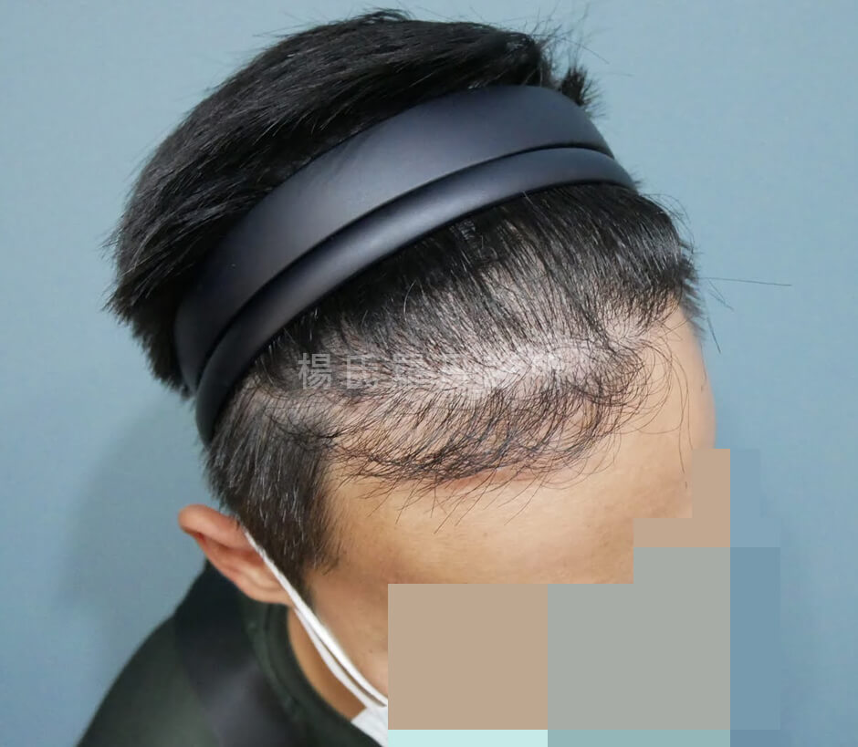 落髮 植髮