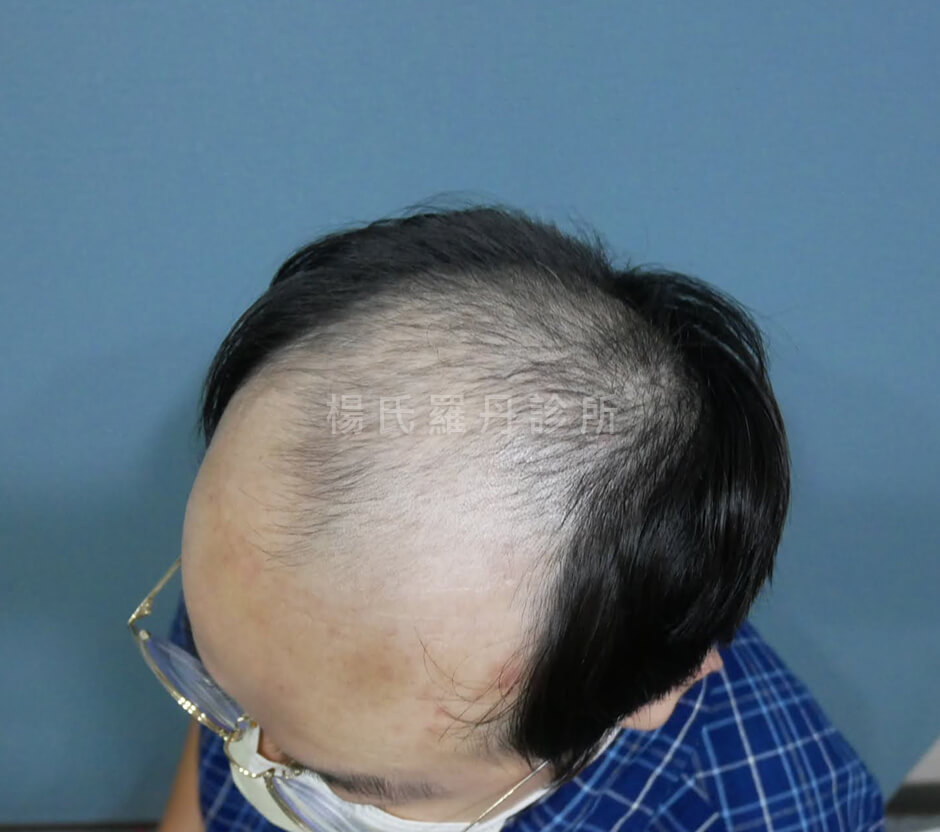 植髮 掉髮