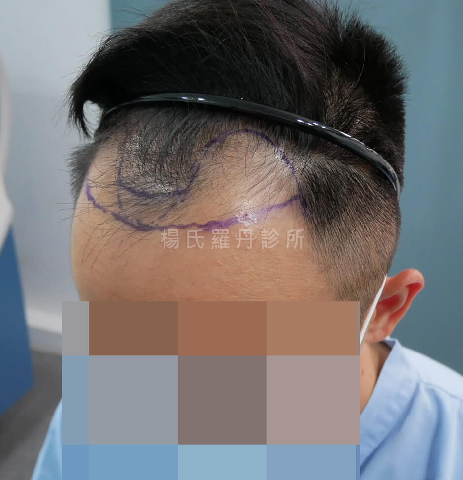 禿頭 植髮