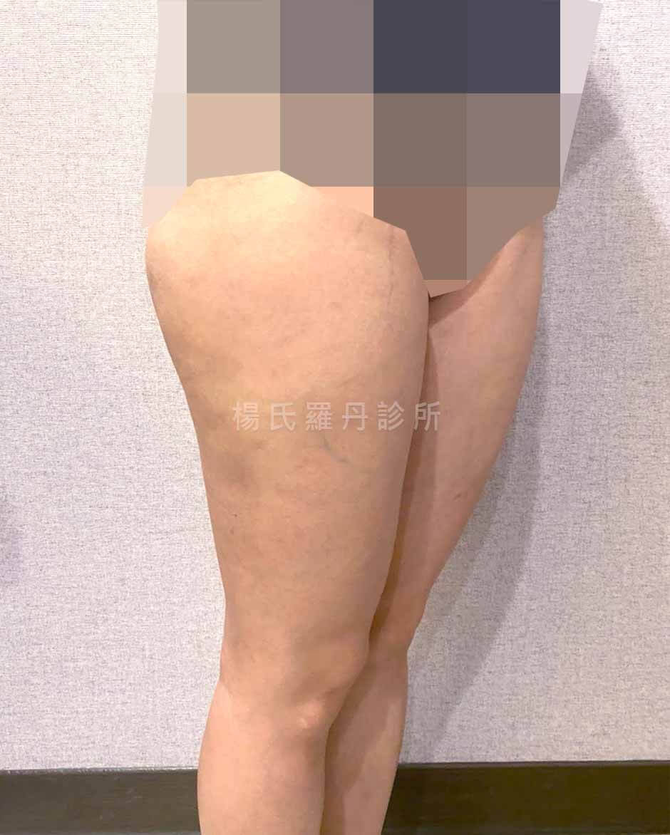 雷射減脂 雕塑 馬鞍肉