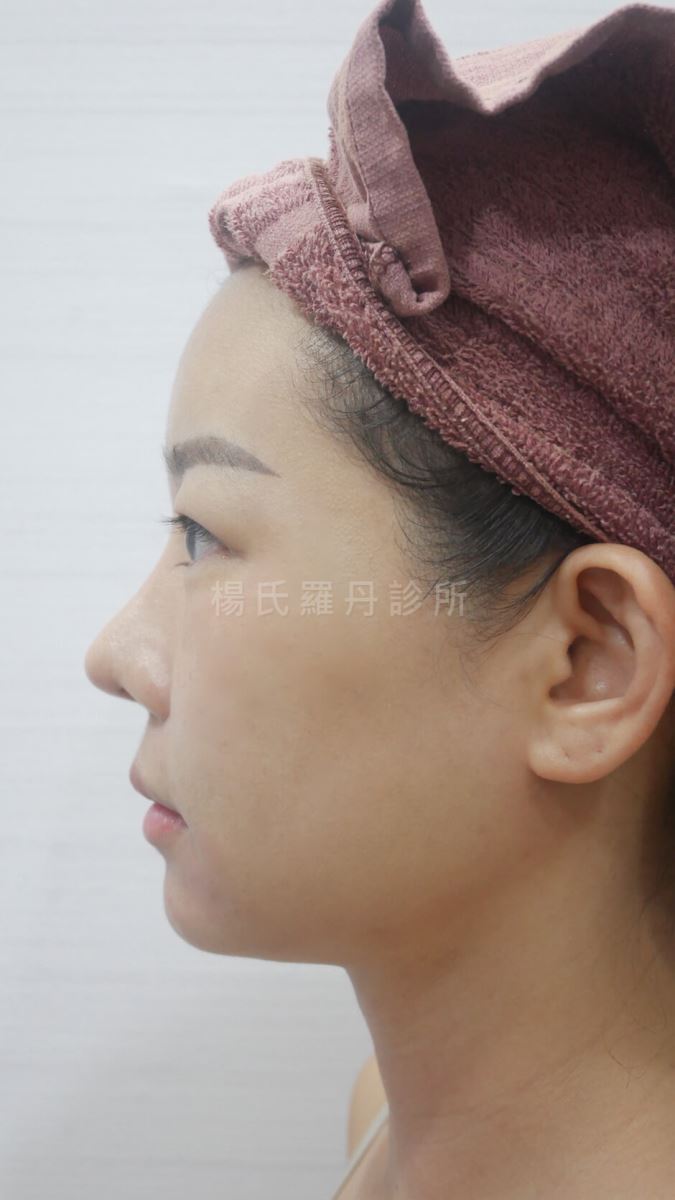 鳳凰電波 電波拉皮