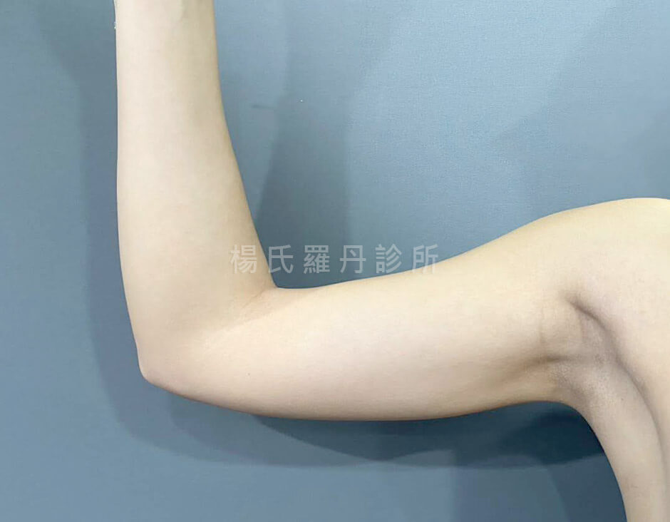 手臂抽脂 瘦手臂 