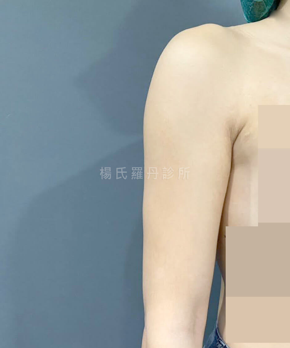 雷射減脂 瘦手臂