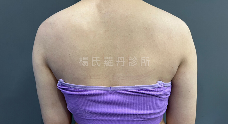 雷射減脂 瘦手臂