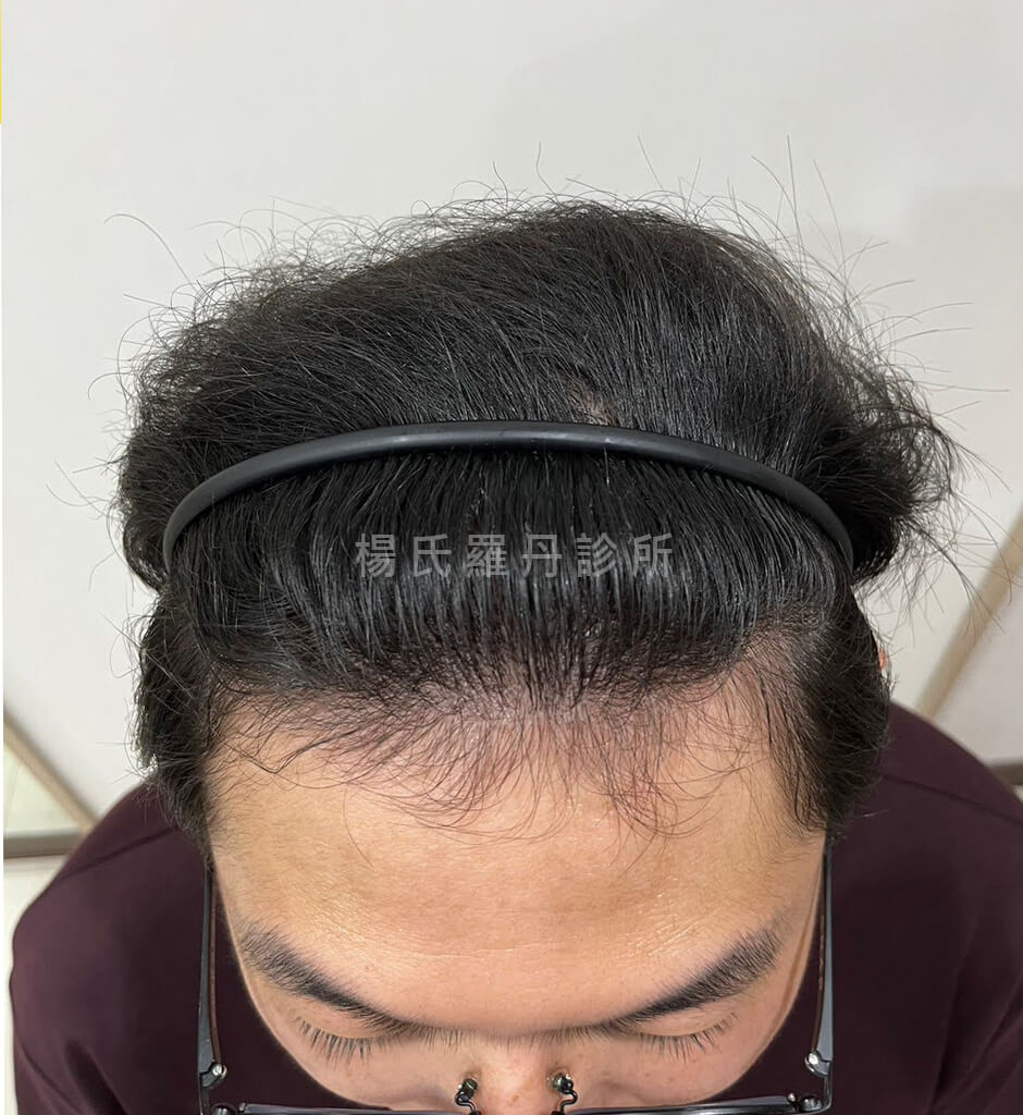 植髮 髮際線植髮