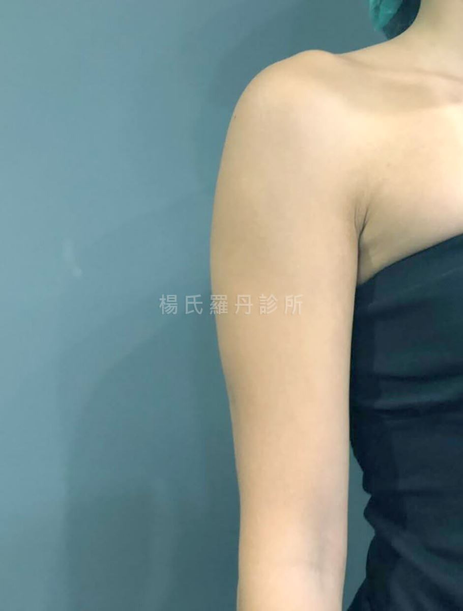 減脂 減脂手術