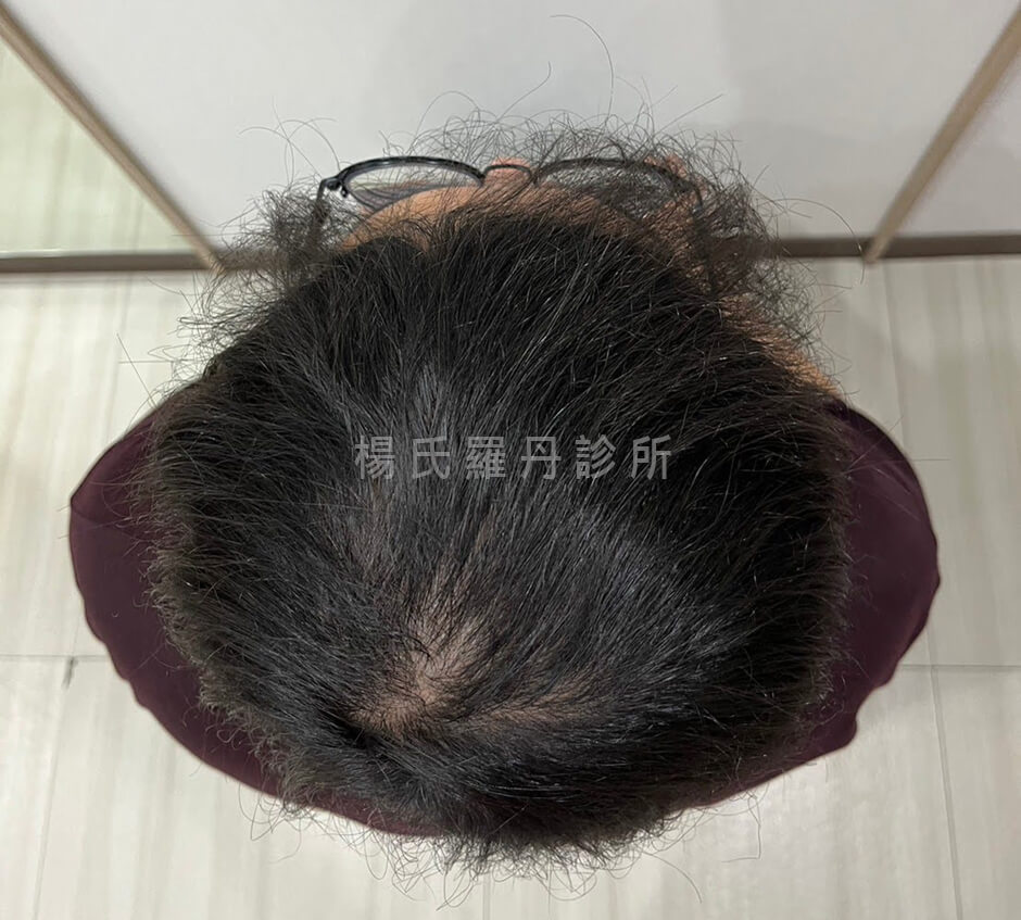 植髮成果 植髮 
