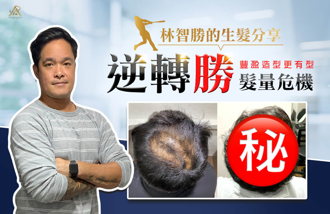 職棒球星,林智勝,生髮,植髮