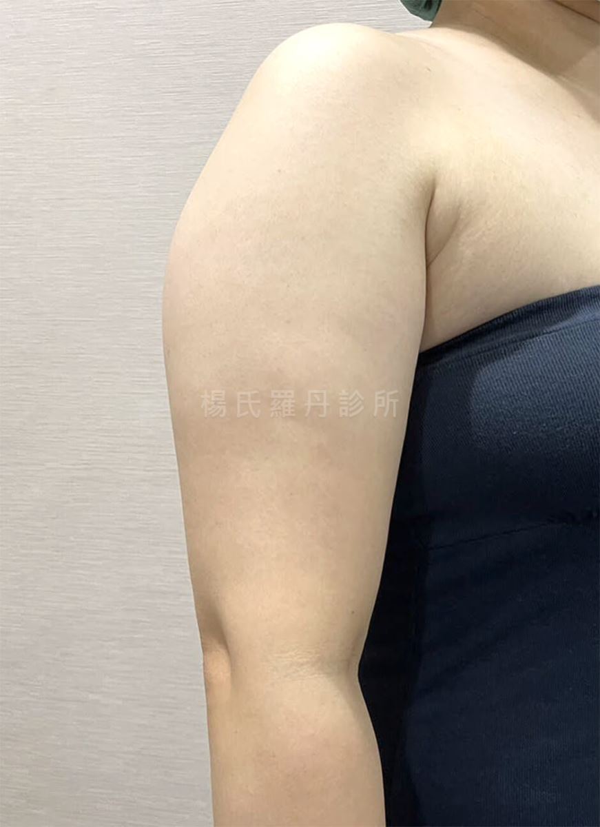 手臂抽脂 抽脂