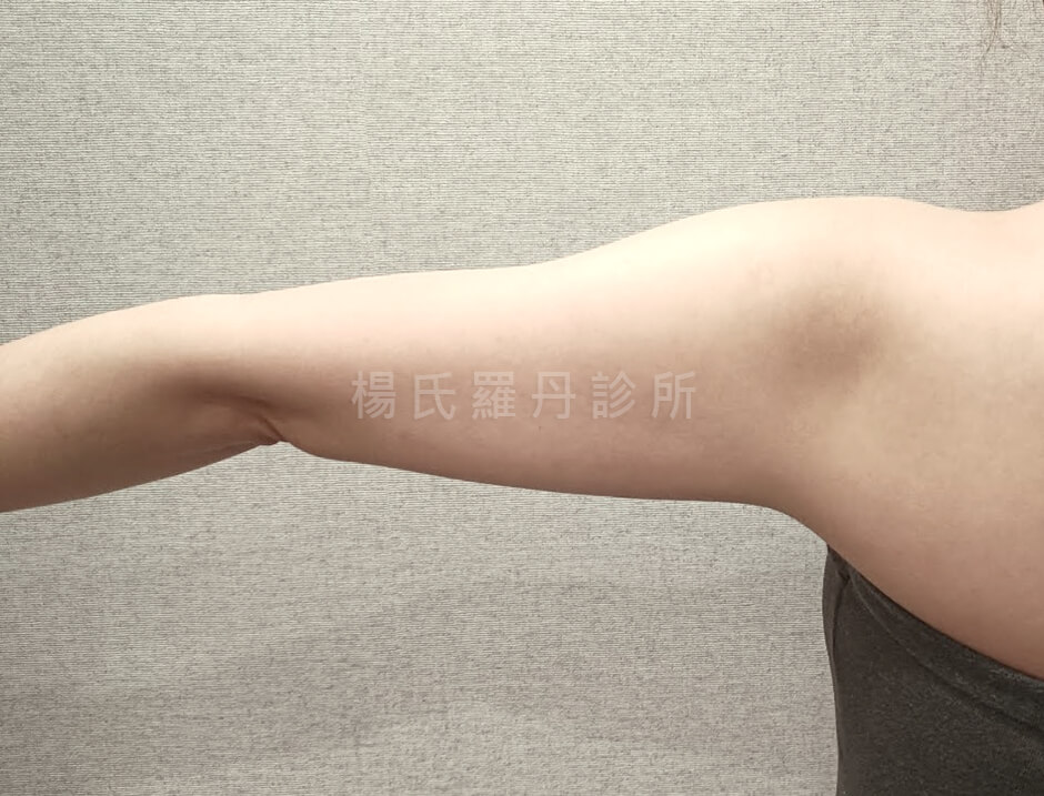 雷射減脂 減脂手術