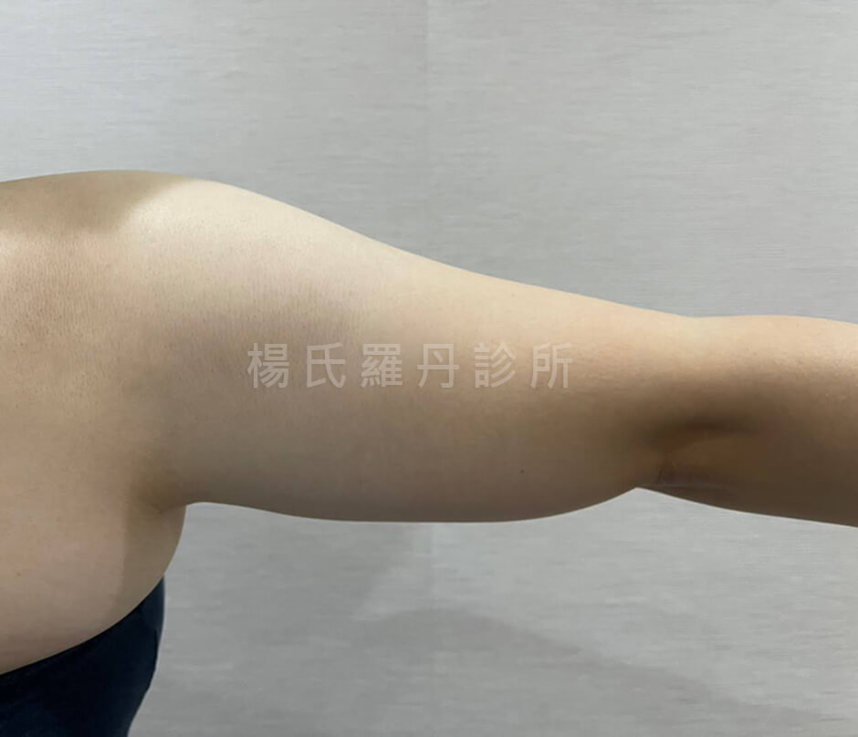 手臂抽脂 瘦手臂