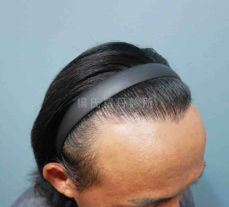 髮際線植髮 植髮