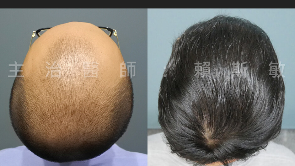 植髮 植髮效果 植髮手術