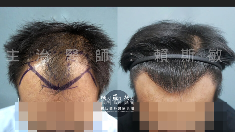 植髮 植髮成果 植髮手術