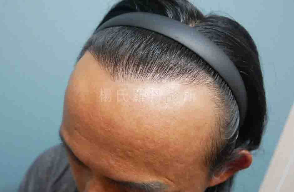 植髮 髮際線 