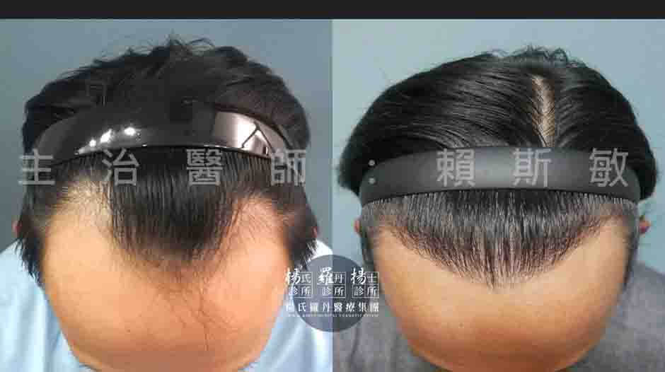 植髮 植髮手術 植髮成果