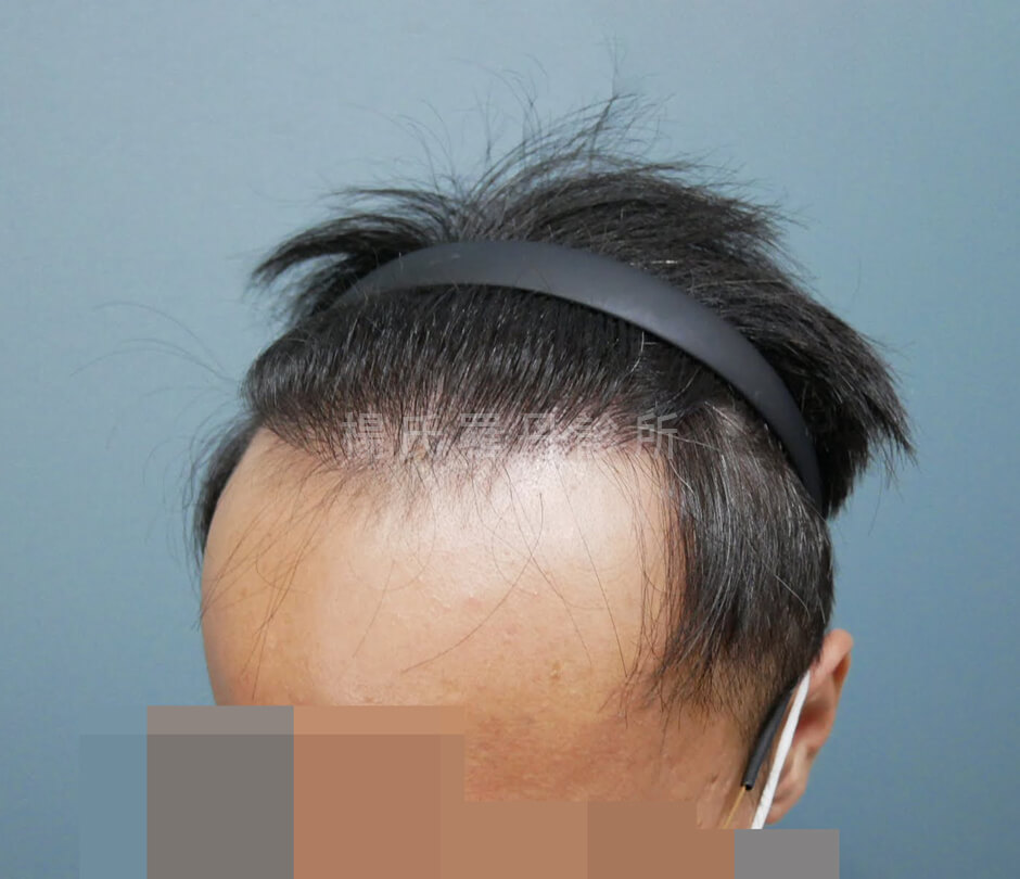 植髮 髮際線植髮
