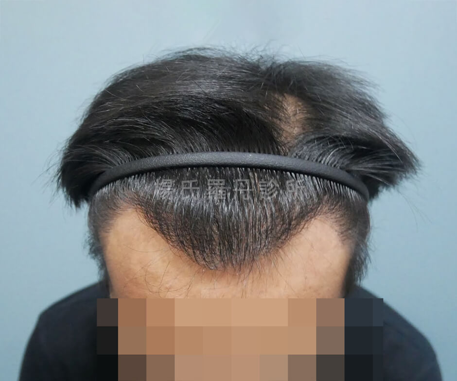 植髮 髮際線