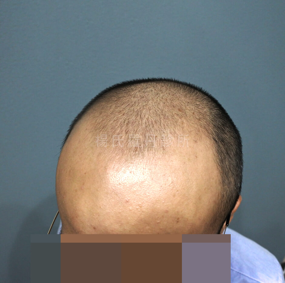 植髮 微創植髮