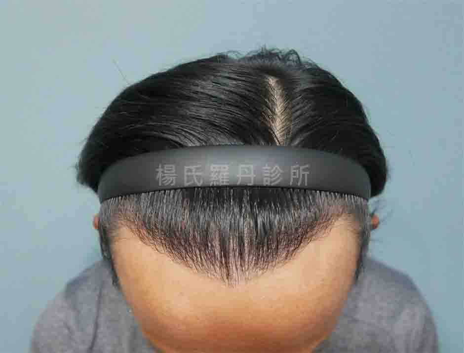植髮 M型禿