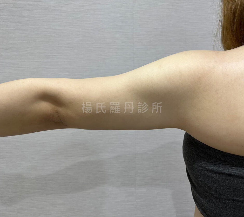 手臂抽脂 掰掰袖