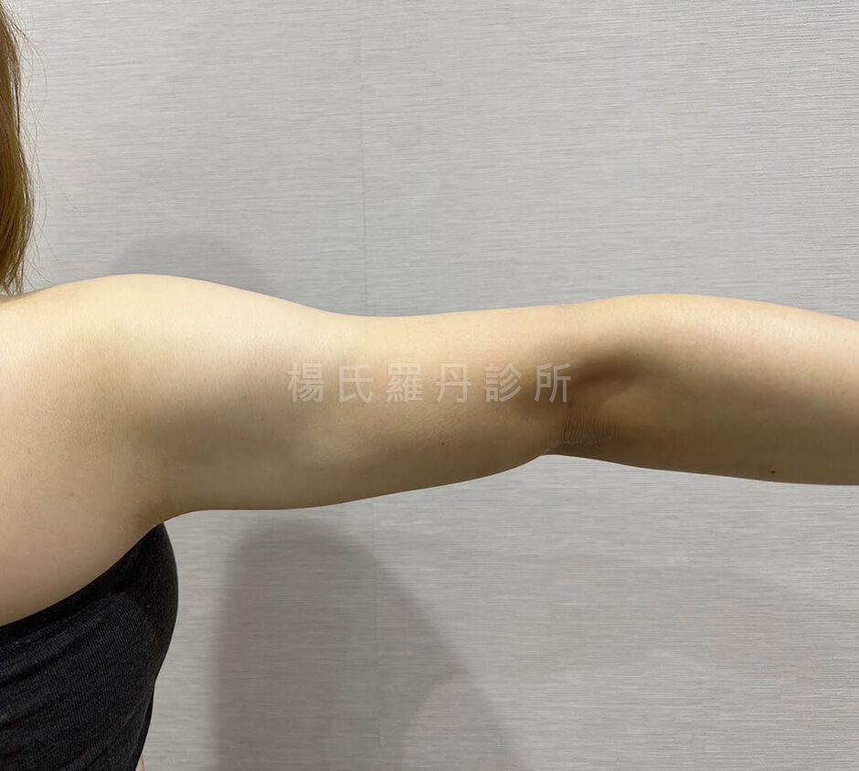 雷射減脂 減脂手術