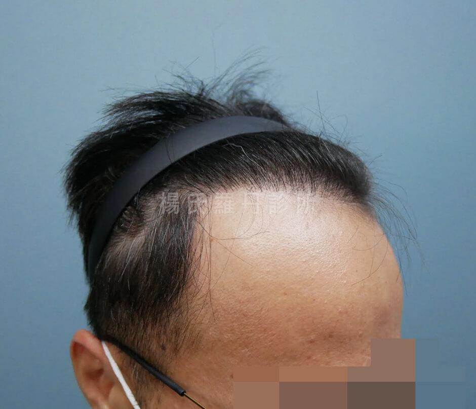 植髮 植髮效果
