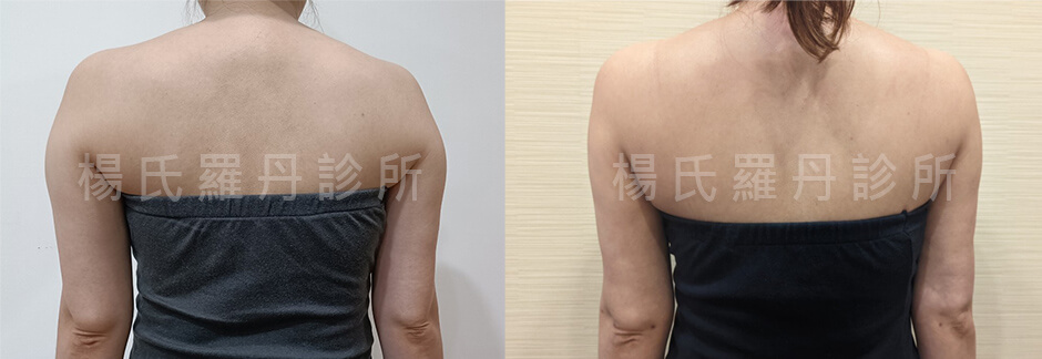 手臂抽脂 抽脂 副乳