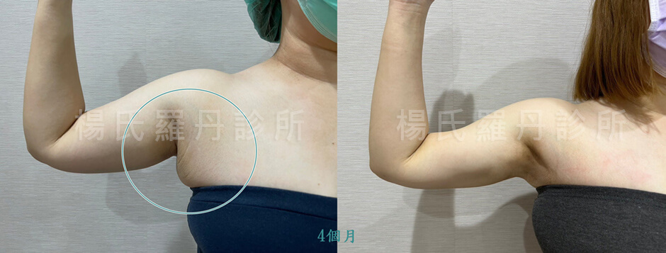 手臂抽脂 副乳 抽脂