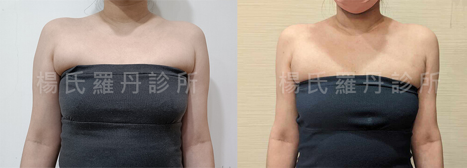 手臂抽脂 副乳 抽脂