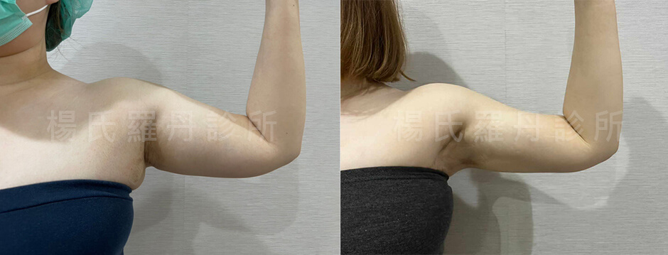 抽脂 手臂抽脂 副乳