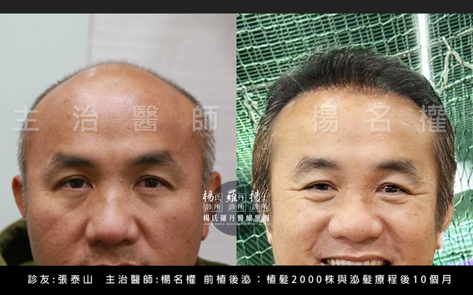 張泰山 前植後泌 育髮