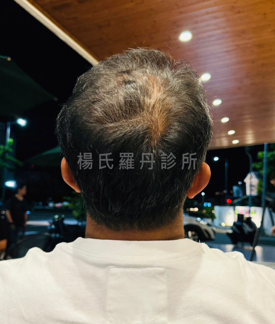 張泰山 前植後泌 楊氏羅丹