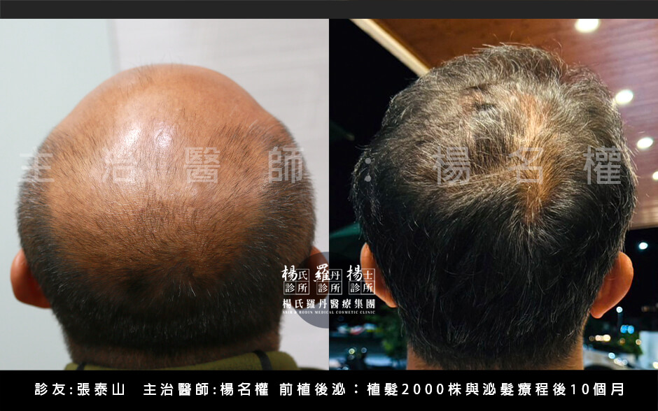 張泰山 前植後泌 楊氏羅丹 植髮