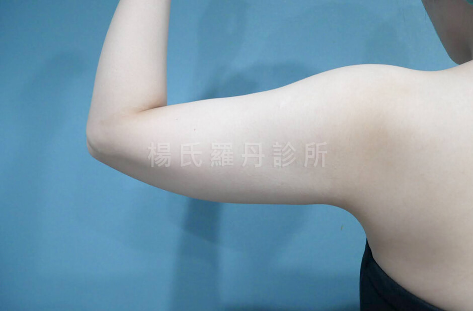 手臂抽脂 雷射減脂 減脂手術