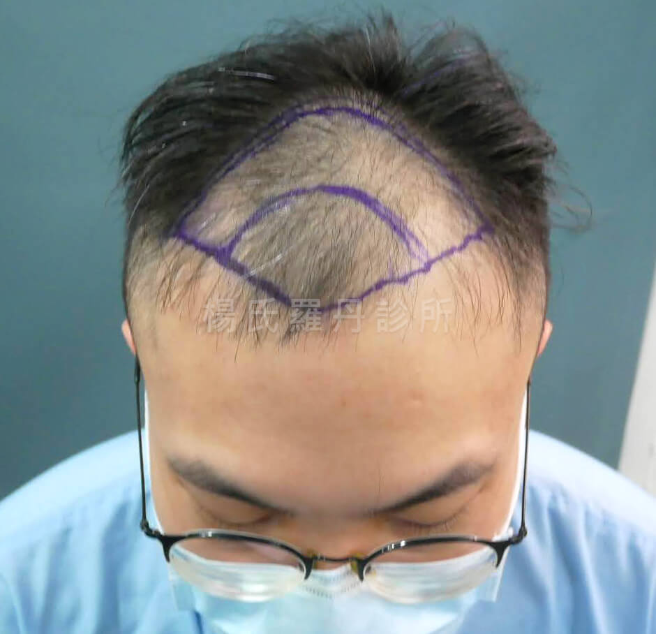 植髮 禿髮