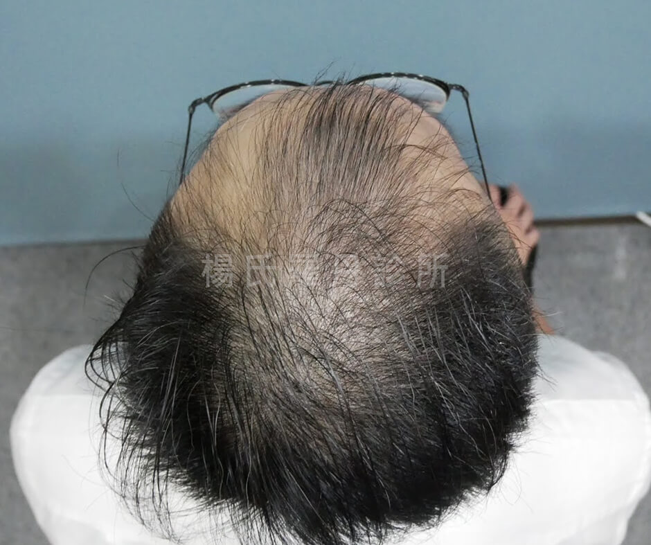 植髮 植髮成果