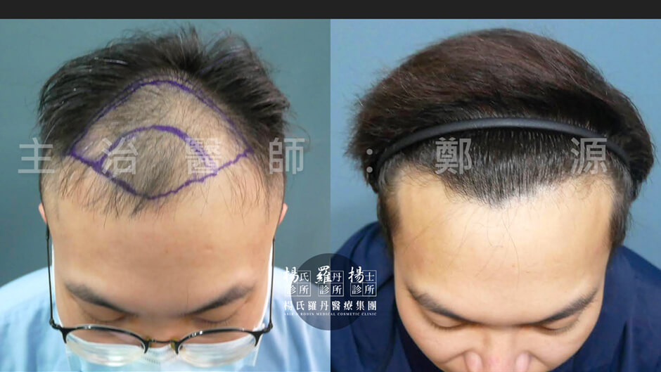 植髮 髮際線 植髮成果