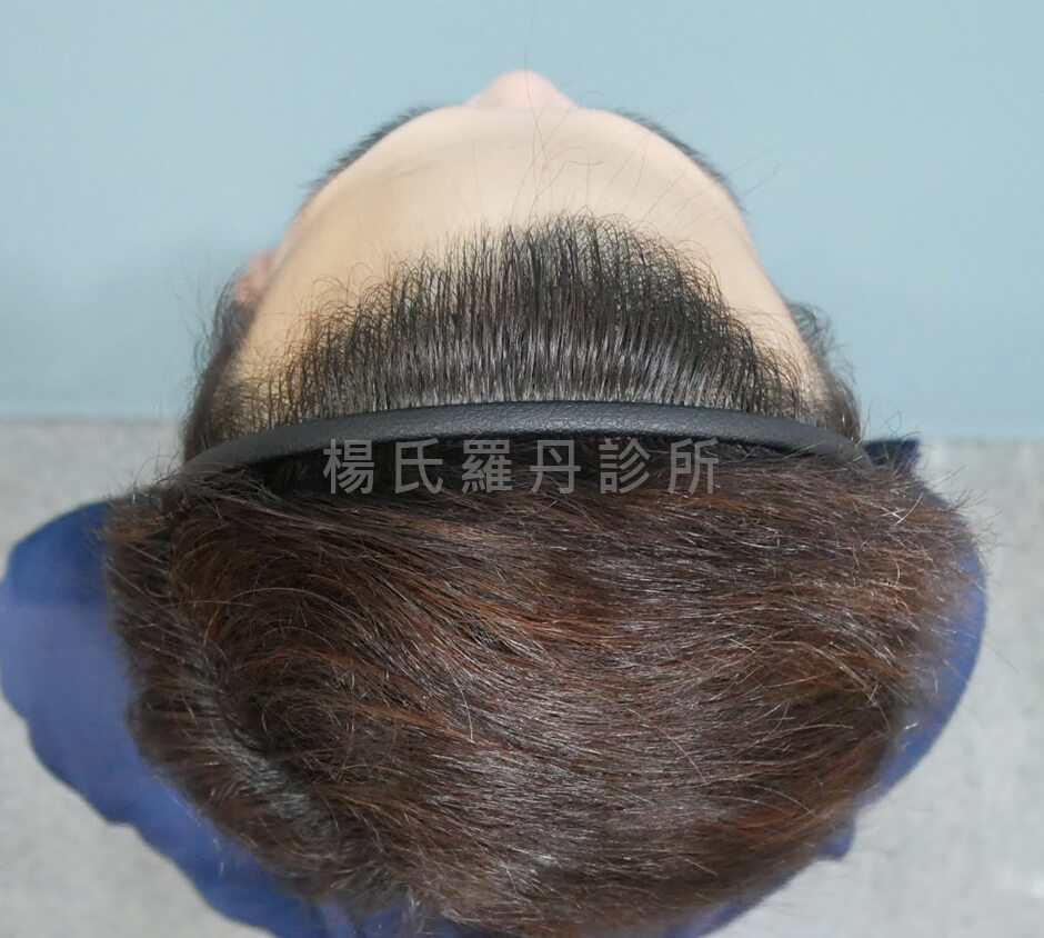 植髮 植髮手術