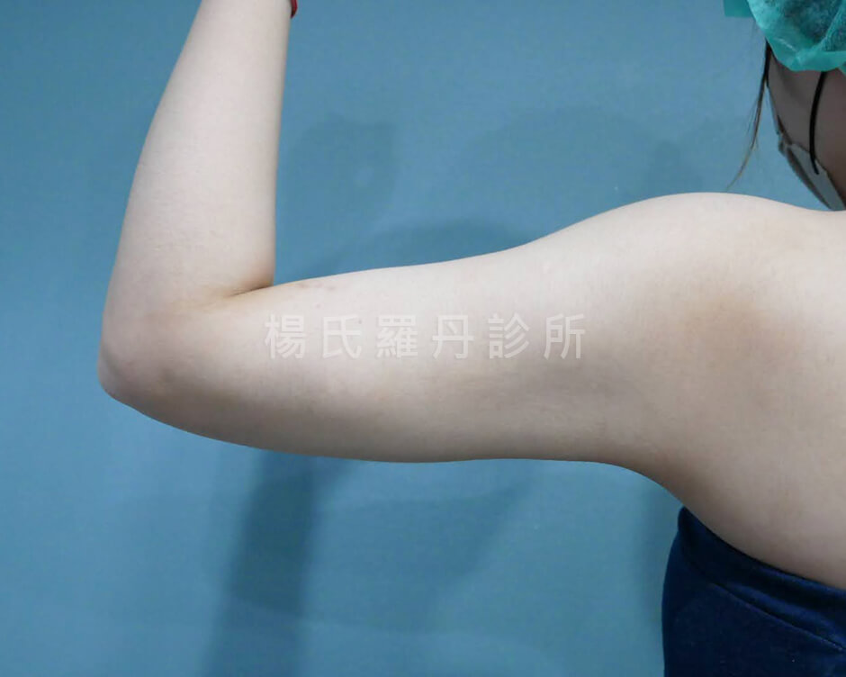 手臂抽脂 雕塑 雷射減脂