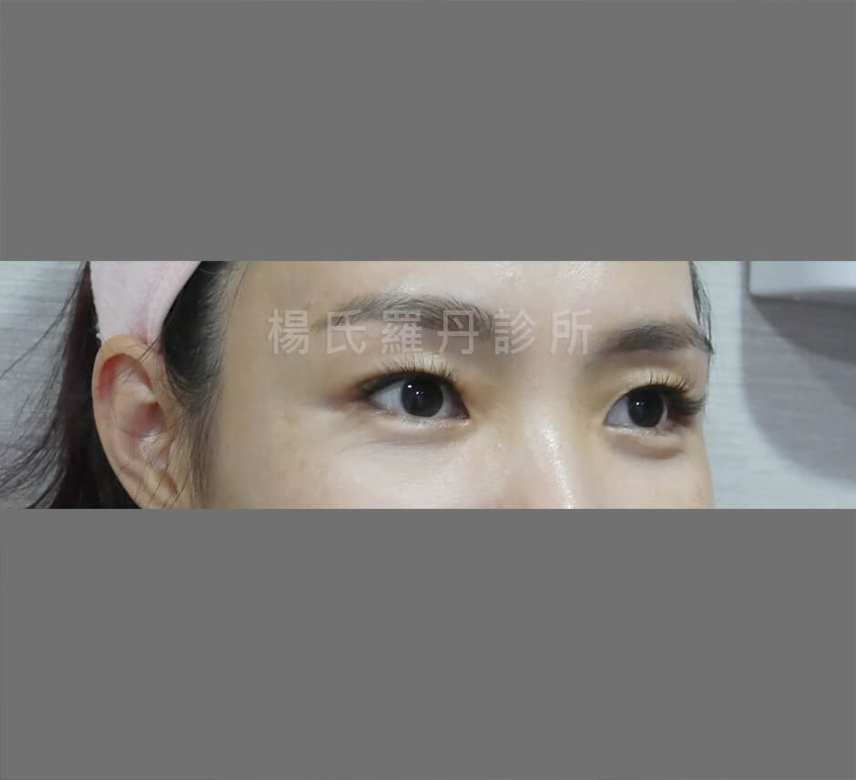 眼袋 淚溝 眼袋手術