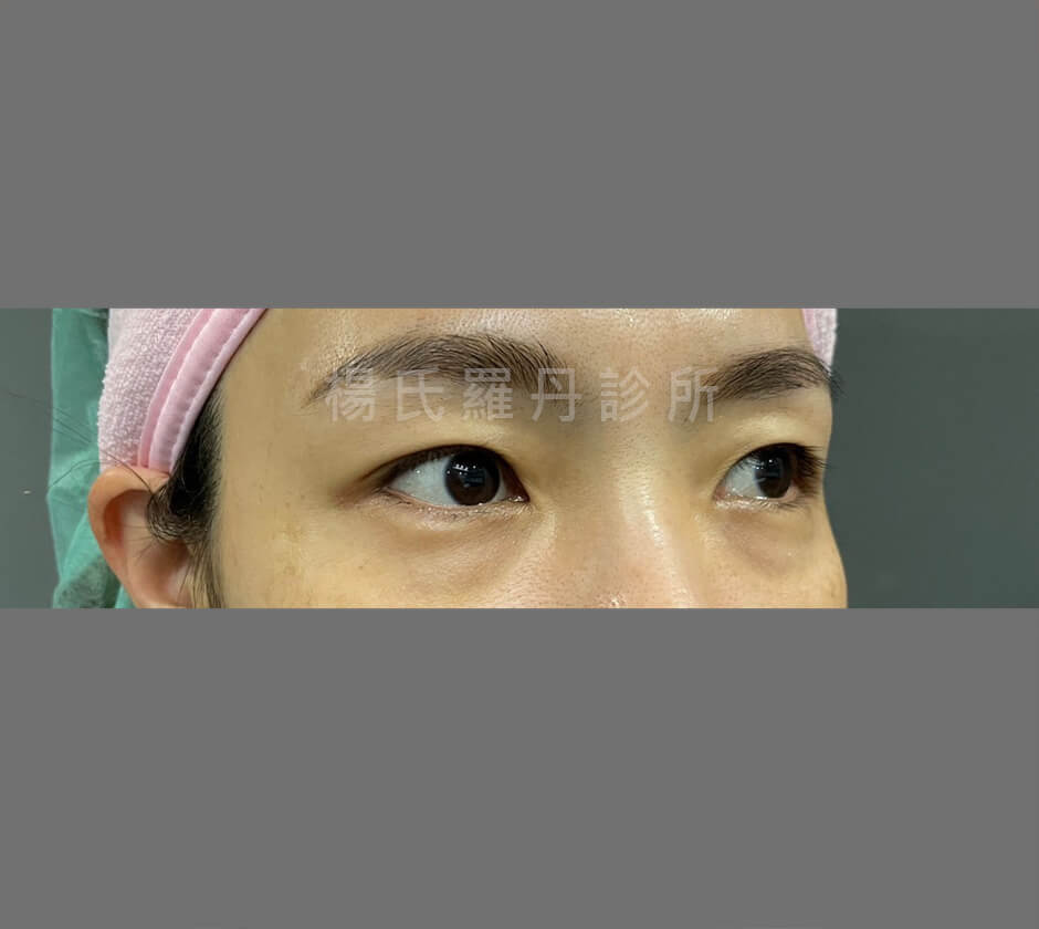 眼袋 淚溝 除眼袋