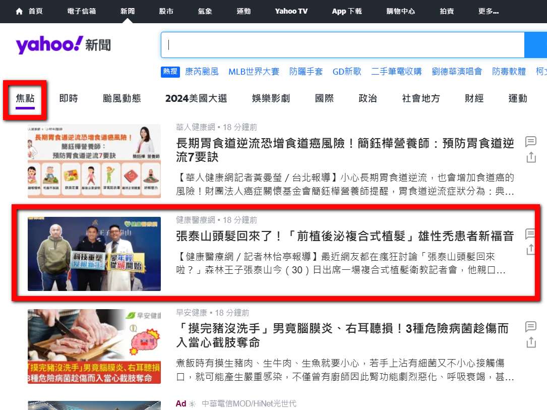 張泰山 前植後泌 植髮