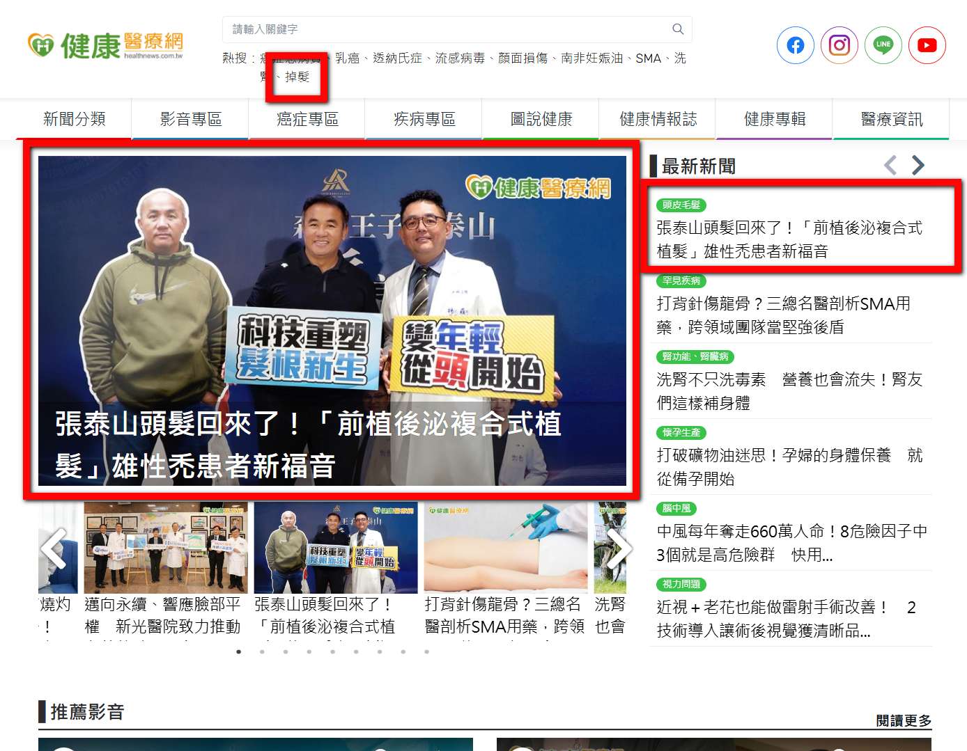 張泰山 前植後泌 掉髮