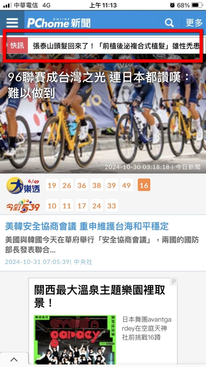 張泰山 植髮 掉髮 前植後泌