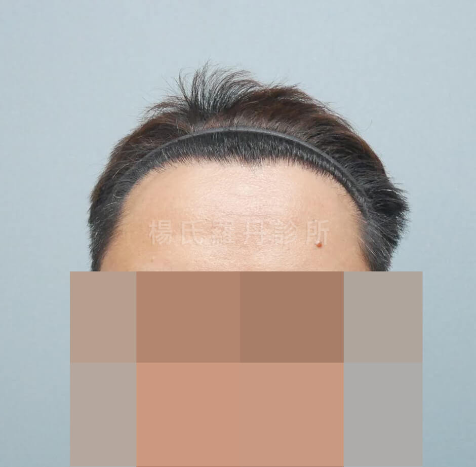 植髮 髮際線