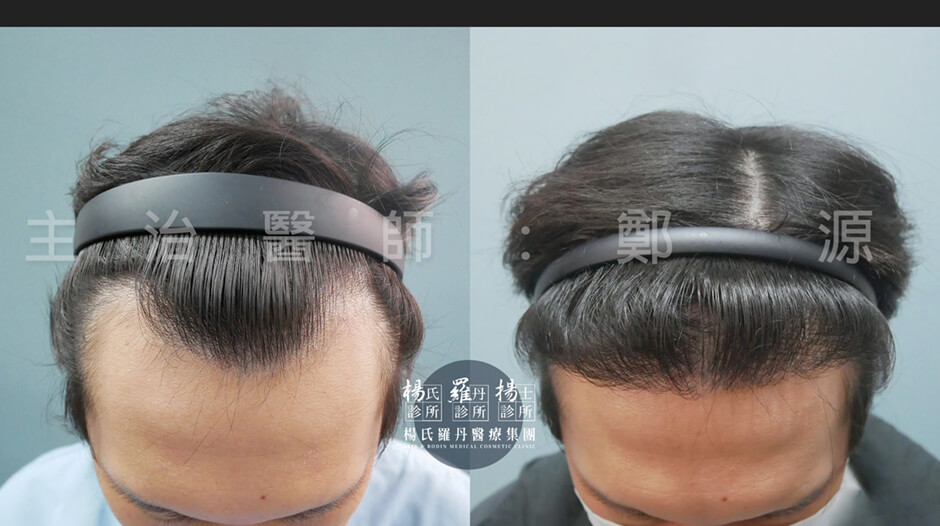 植髮 M型禿 植髮成果