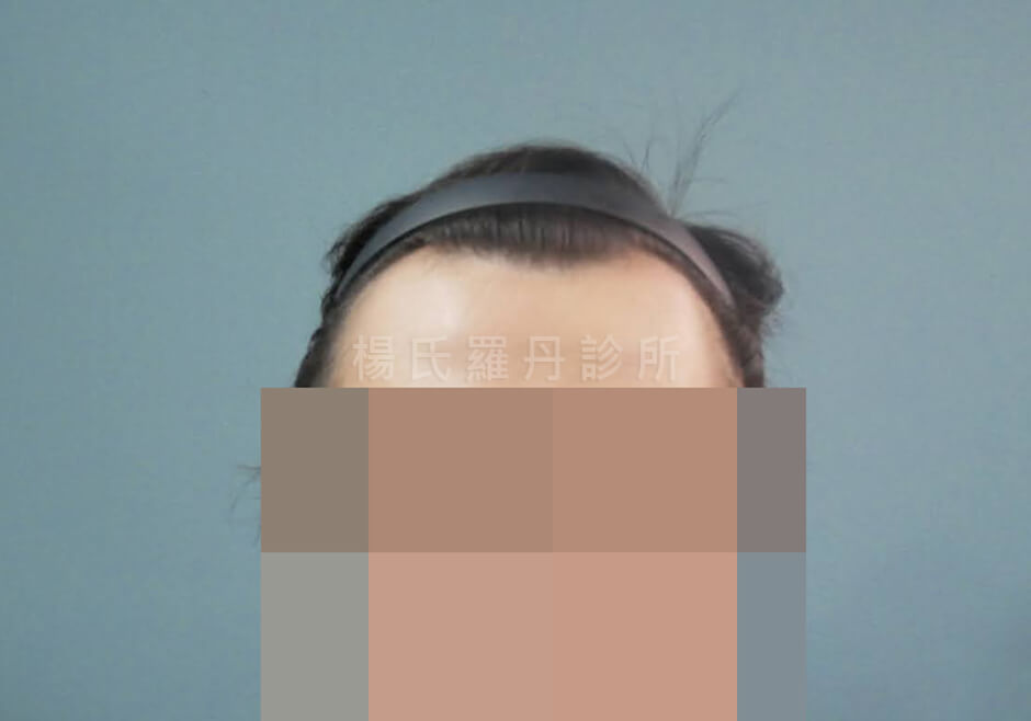 植髮 M型禿